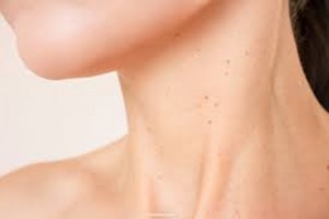 Skin Tag Removal Bangkok: